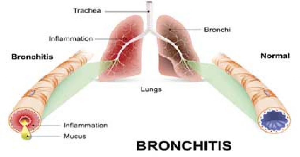 Acute Bronchitis Massage