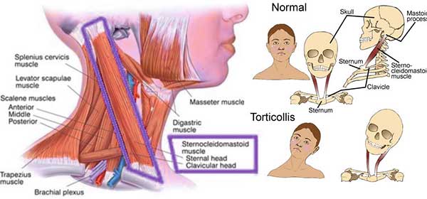 How To Treat Torticollis In Adults