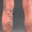 varicose veins