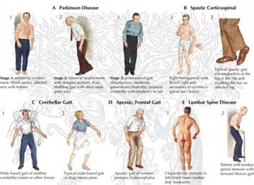 Abnormal Gaits - Problems with Walking - Massage Therapy