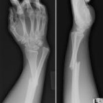 fracture-massage