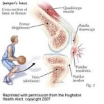 jumpers-knee-massage