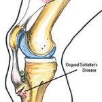 osgood-schlatter-massage