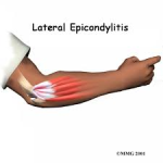 tennis elbow massage