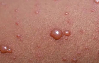Chickenpox (varicella) massage
