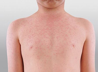 measles rash massage