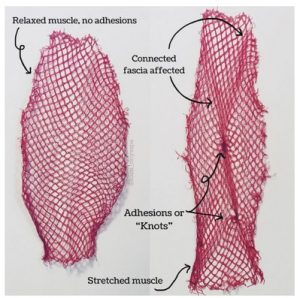 fascia adhesions knots