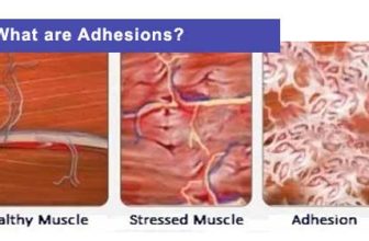 What Are Adhesions?