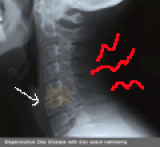 Degenerative Disc Disease Massage