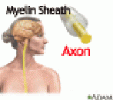 Multiple Sclerosis Massage