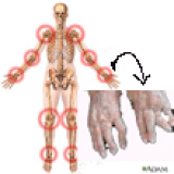 Rheumatoid Arthritis Massage