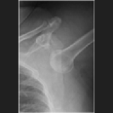 Joint Dislocation Massage