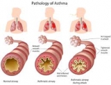 Asthma Massage