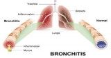 Acute Bronchitis Massage