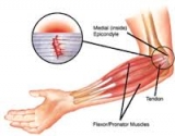 Golfer’s Elbow Massage