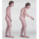 Hyperkyphosis Massage