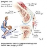 Patellar Tendonitis/ Jumper’s Knee Massage