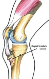 Osgood Schlatter’s Disease Massage