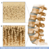 Osteoporosis Massage