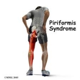 Piriformis Syndrome Massage