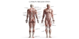 Trigger Points: What Are They, Causes, Effects, Symptoms